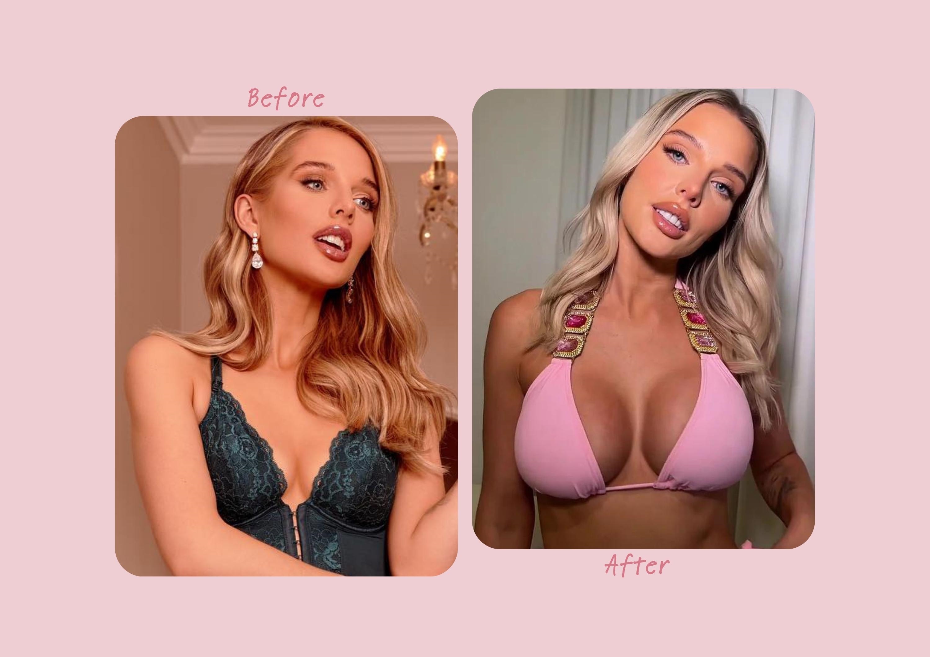 Helen Flanagan before and after breast enlargement Helen Flanagan before and after breast enlargement